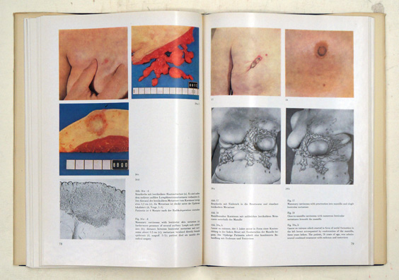 Atlas zur Klinischen Diagnostik des Brustdrüsenkrebses - Atlas on the Clinical Diagnosis of Mammary Carcinoma